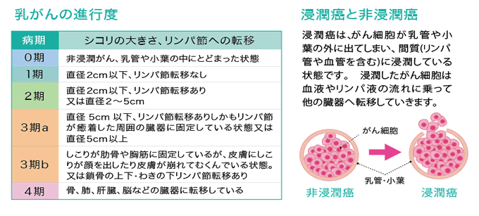 表:乳がんの進行度0期~4期