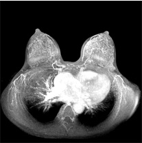 乳腺MRI検査画像イメージ