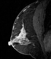 乳腺MRI検査画像イメージ2